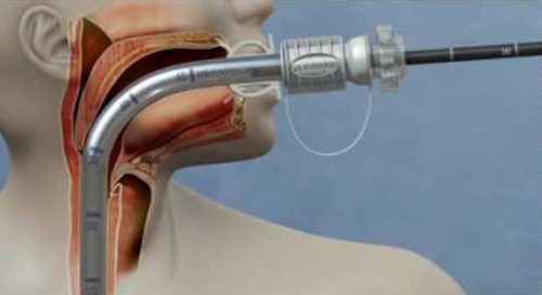 Accessory Devices – Vantage Endoscopy